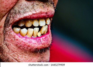 Broken Teeth Stain Detail Smoking Stock Photo 1445279909 | Shutterstock