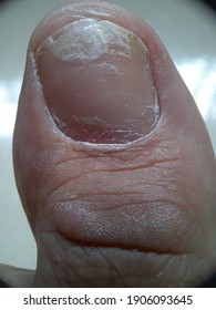 Broken Thumbnail With Very Dry Skin