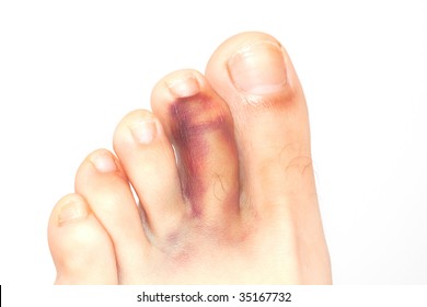 Broken Toe Cartoon Images