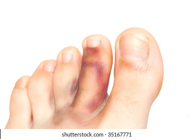 Broken Toe Isolated On White.