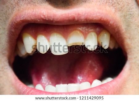 Similar – gap between one’s teeth