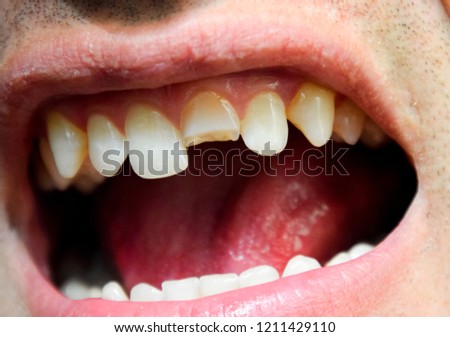 gap between one’s teeth