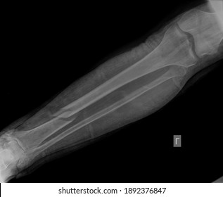 Broken X Ray Image Leg Stock Photo 1892376847 | Shutterstock