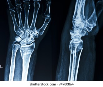 Broken X-ray Of Human Hand Wrist.