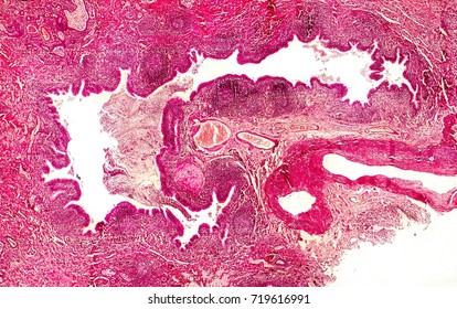 Bronchiectasis, cross-section through bronchus. Light photomicrograph showing dilatated and distorted bronchus containing pus