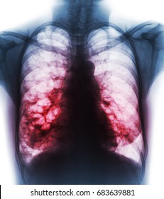 Bronchiectasis .  X-ray Chest Show Multiple Lung Bleb And Cyst Due To Chronic Infection . Front View .