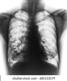 Bronchiectasis .  X-ray Chest Show Multiple Lung Bleb And Cyst Due To Chronic Infection . Front View .