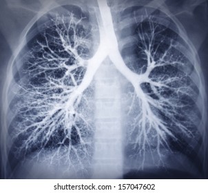 Bronchoscopy image. Chest X-ray. Healthy lungs