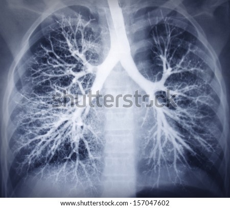 Bronchoscopy image. Chest X-ray. Healthy lungs