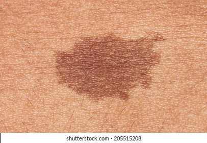 Brown Birthmark. Dark Skin Texture Of Woman