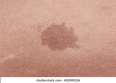 Brown Birthmark. Dark Skin Texture Of Woman