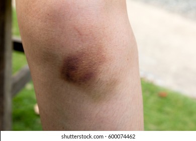 Severe Bruise Stock Photo 95524330 | Shutterstock