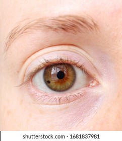 Brown Eye With Nevus On The Iris