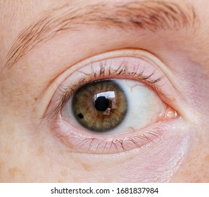 Brown Eye With Nevus On The Iris