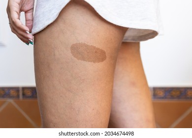 Brown Melanoma, Angioma, Or Birthmark. Woman Dark Skin Texture