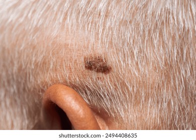 Brown mole on the head of an elderly person, nevus and melanoma.