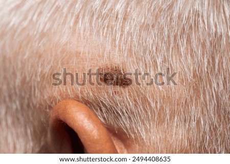 Brown mole on the head of an elderly person, nevus and melanoma.