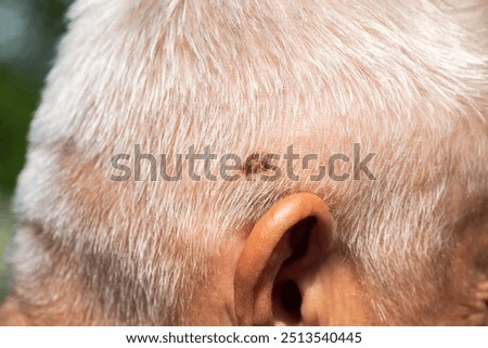 Brown mole on the head of an elderly person, nevus and melanoma.