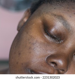 Brown skin with dark spots, hyperpigmentation on brown skin, african american woman with skin blemishes, imperfect skin