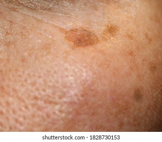 Brown Spot On The Skin Of The Face. Pigmentation On The Skin