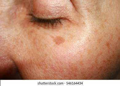 Brown spots under the eye. Pigmentation on the face.