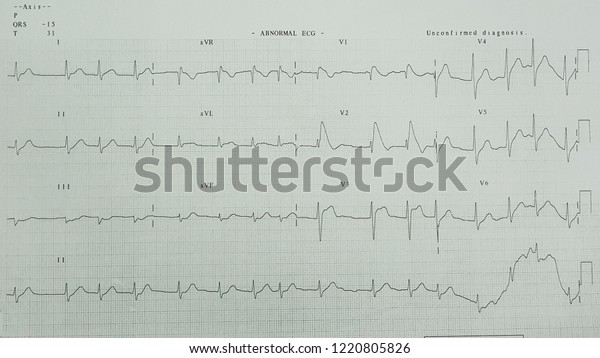 Brugada Syndrome Type 1 Coved Type Stock Photo 1220805826 | Shutterstock