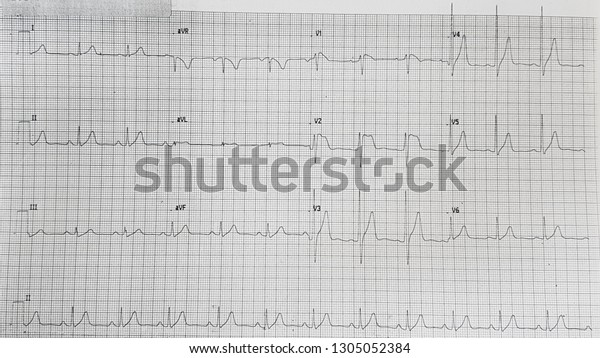 Brugada Syndrome Type1 Coved Type Stock Photo 1305052384 | Shutterstock