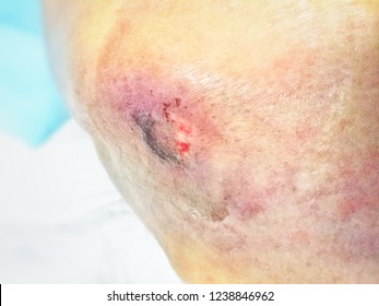 Bruise, Bedsore, Pressure Ulcer,  Wound