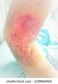 Bruise, Bedsore, Pressure Ulcer,  Wound