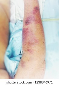 Bruise, Bedsore, Pressure Ulcer,  Wound