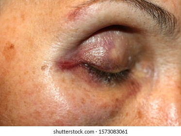 A Bruise Near The Eye. Hematoma On The Face From A Blow. Eye Injury.