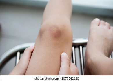 A Bruise On Children Knee , Kid Get Hurt From Fall Injuries , Medical And Healthcare Concept