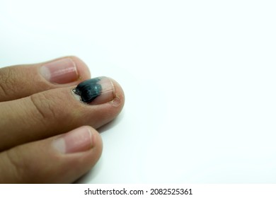 A Bruise On The Finger Nail. Concept Of A Safety Violation