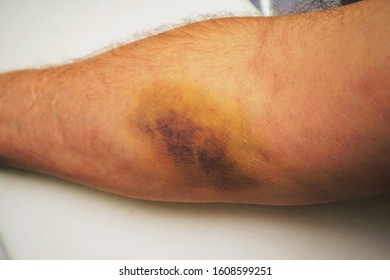 A Bruise On The Forearm Caused By A Syringe