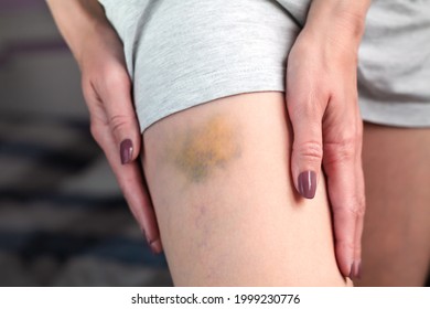 Bruise On The Leg Of A Woman. A Bruised Leg. Close-up.