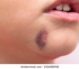 Bruise On The Skin Of The Face