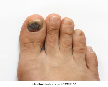 Bruise On Toe Nail On Right Foot