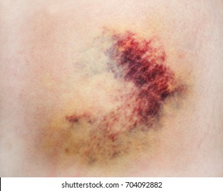 Bruise On White Skin. Close-up Photo