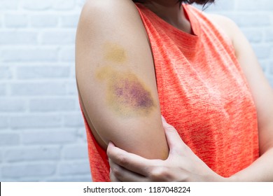 Bruise On Woman Arm. Injection Bruises. 