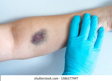 Bruise On Woman Arm. Injection Bruises.