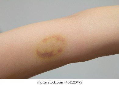 Bruise Wound Female Arm