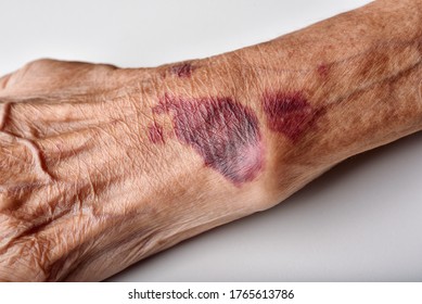 Bruise Wound On Senior People Wrist Arm Skin, Falls Injury Accident In Elderly Old Man.