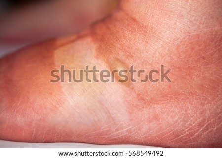Bruised woman foot with burn blisters