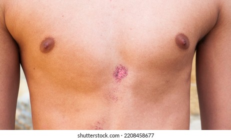 Bruised Wound In Chest Skin