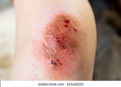 怪我 の画像 写真素材 ベクター画像 Shutterstock