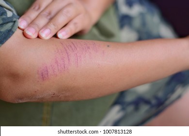 Bruised Wound On Woman's Arm.