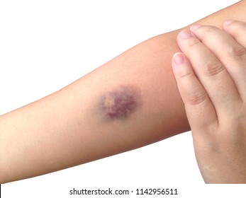 Bruises from blood collection isolated on white background.