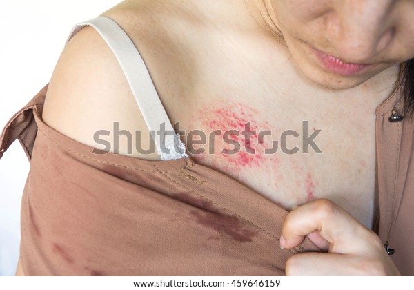 Bruises After Sex