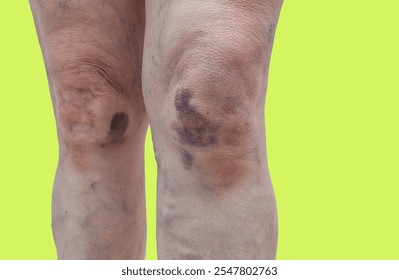 Bruises on an elderly woman's leg after a fall - Powered by Shutterstock