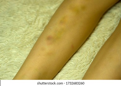 Bruises On The Feet Of A Small Child After Falling For A Walk.